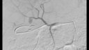 Atrium V12 hepatic pseudoaneurysm exclusion